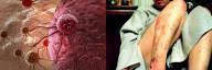 Cancer vs Psoriasis