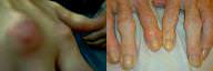 Osteoarthritis vs Gout