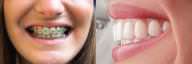 Braces vs Invisalign