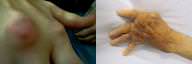 Gout vs Rheumatoid Arthritis