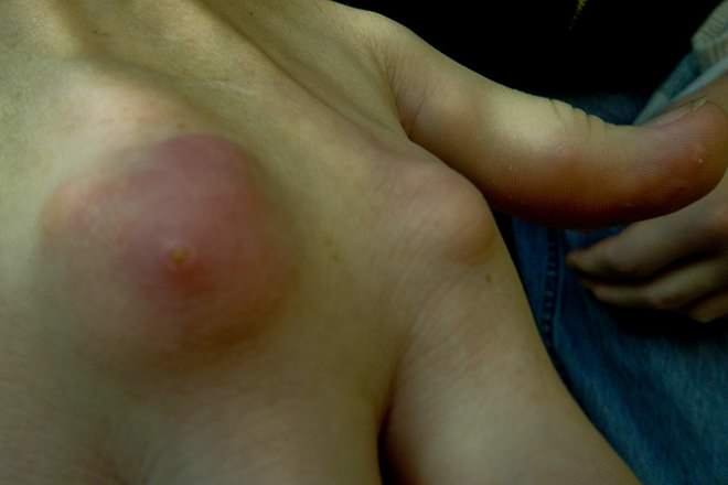 Gout