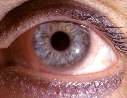 The thin film of transparent contact lens can be seen around the pupil