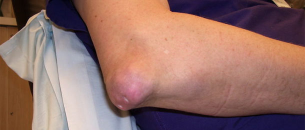 The whitish markings on the surface of this gouty elbow are tophi.