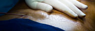 Liposuction vs Tummy Tuck