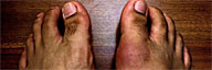 Gout vs Pseudogout