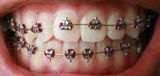 Braces